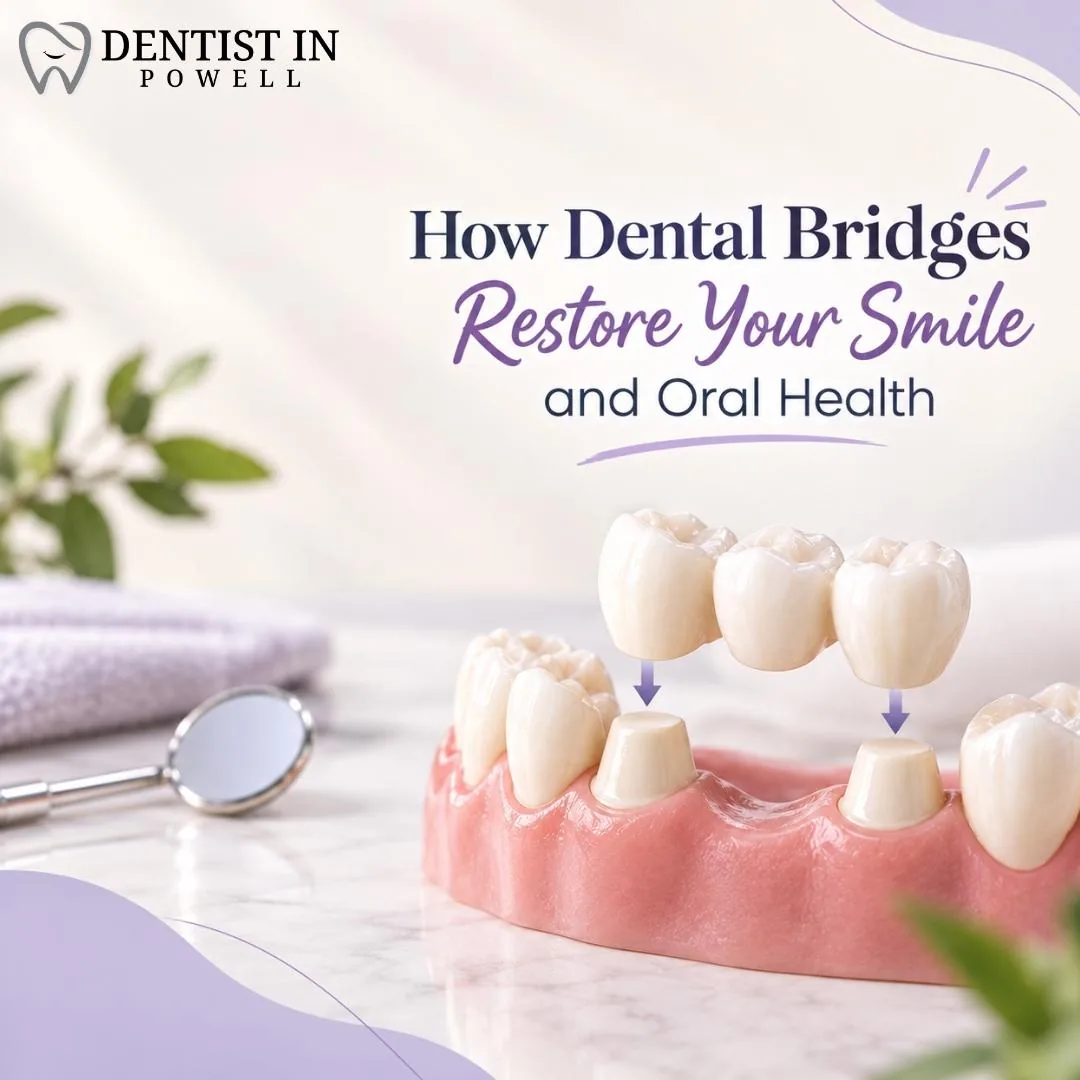 How Dental Bridges Restore Your Smile And Oral Health