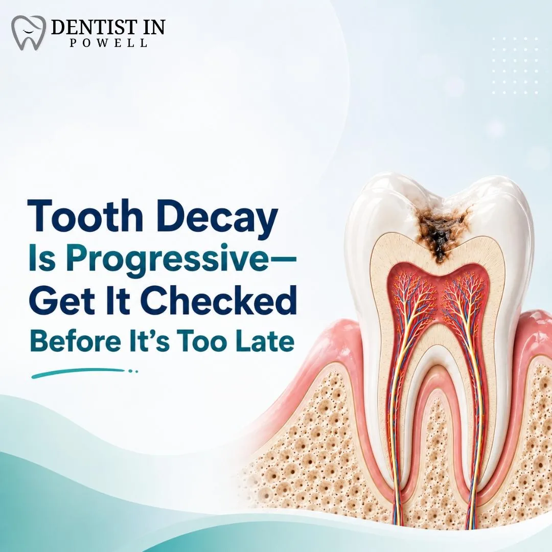 Tooth Decay Is Progressive—Get It Checked Before It's Too Late