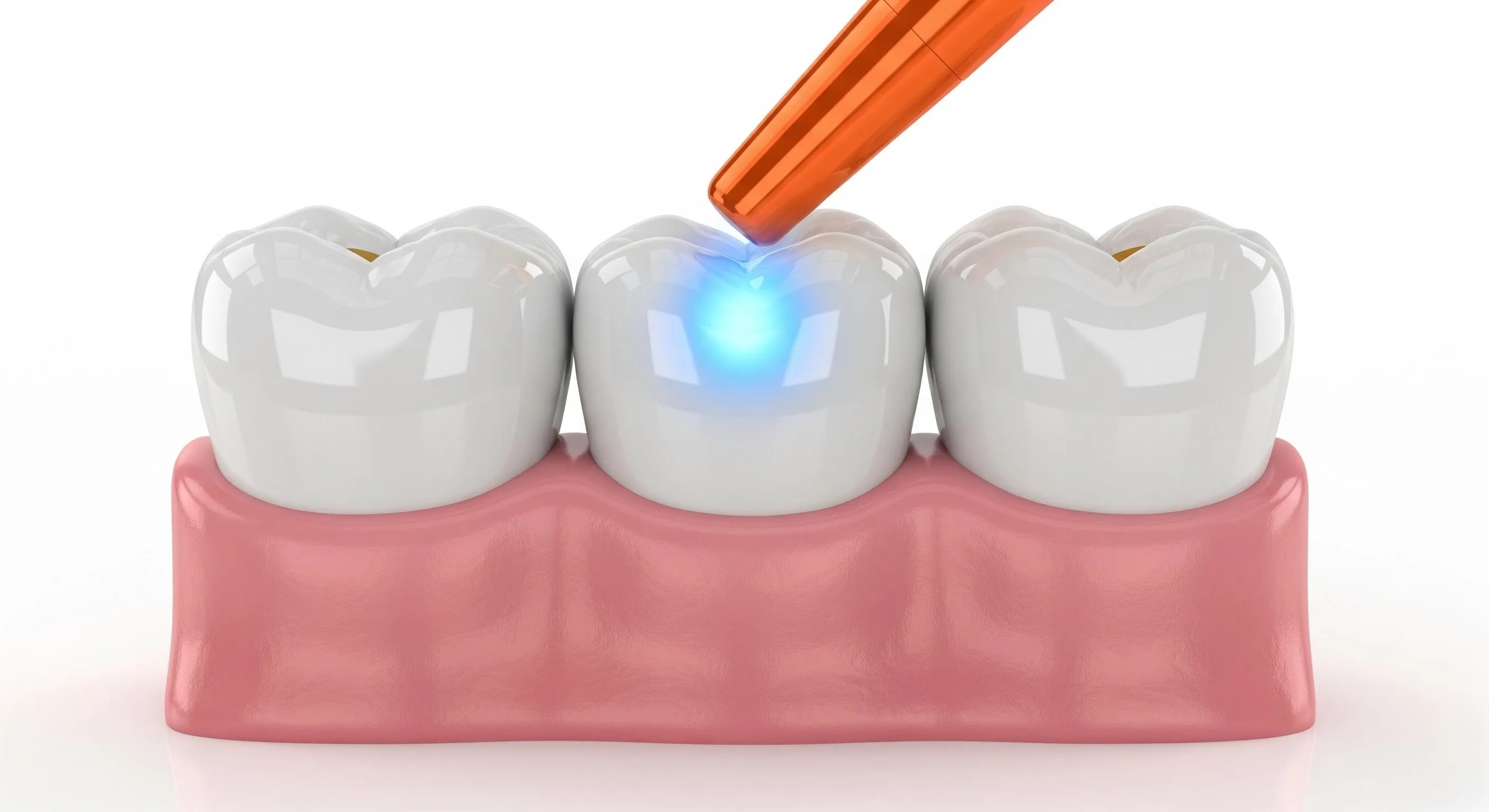 Composite Fillings Cost and Pricing Information in Powell