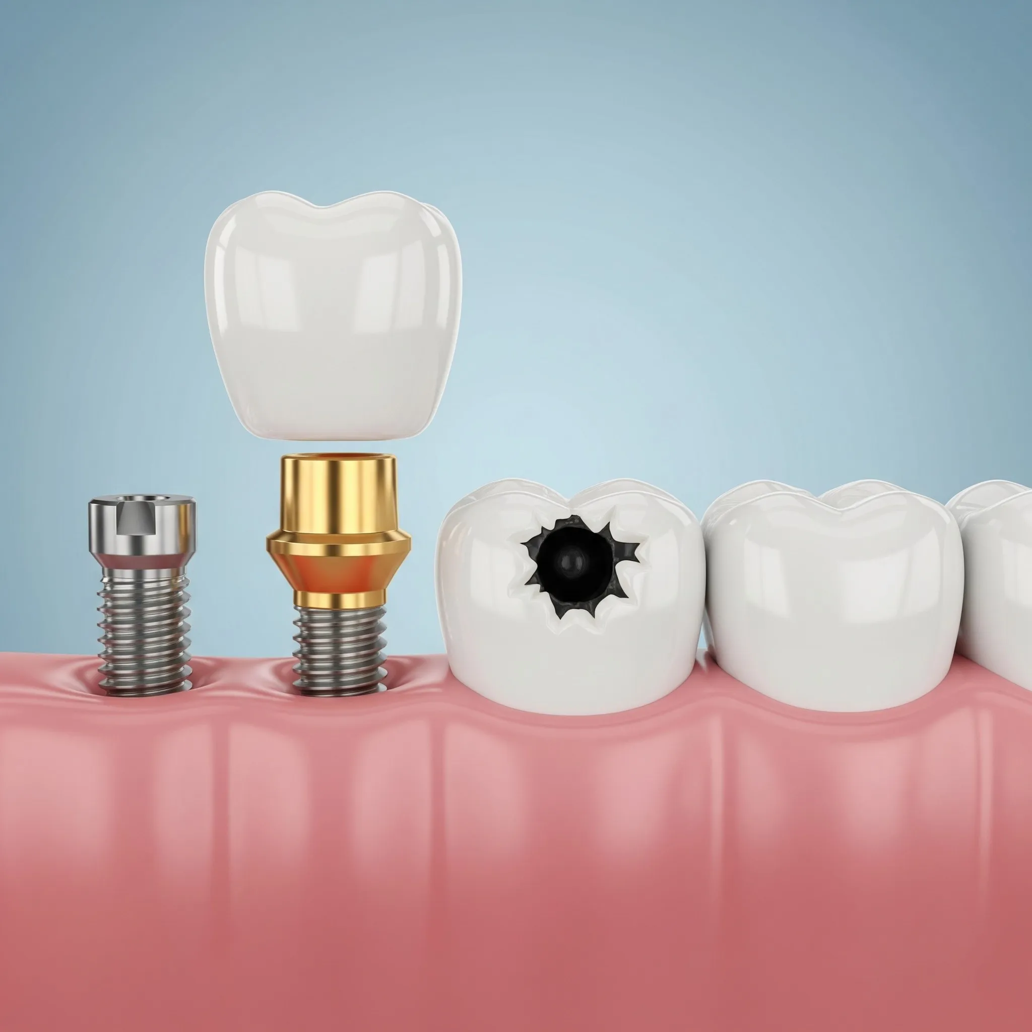 What Is Restorative Dentistry